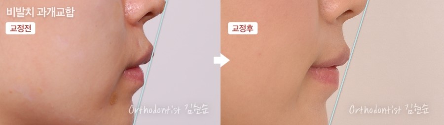 과개교합 무턱 개선 관련 이미지 13