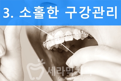 치아교정을 하면 입 냄새가 많이 나요? 관련 이미지 6