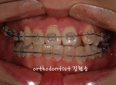 강남 덧니, 돌출 관련 이미지 18
