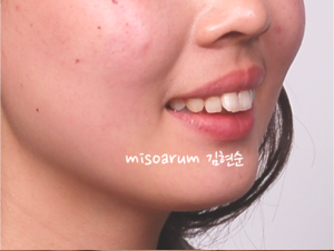 강남 돌출입 교정 관련 이미지 4