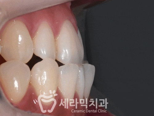 반대교합과 아래 돌출입 치아교정전후 관련 이미지 6