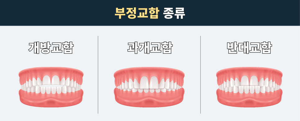 치아가 반대로 물리는 관련 이미지 2