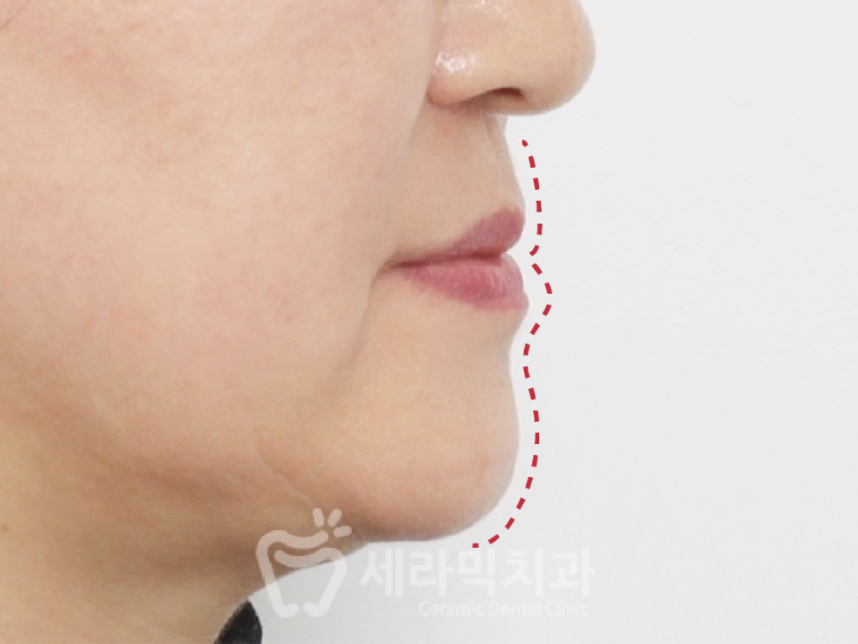 40대에 이어 50대 치아교정 전후사례 증가 추세 관련 이미지 11