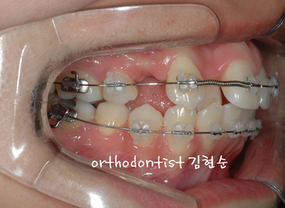 강남 돌출 관련 이미지 15