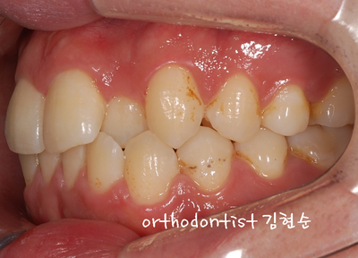 반대교합 관련 이미지 8