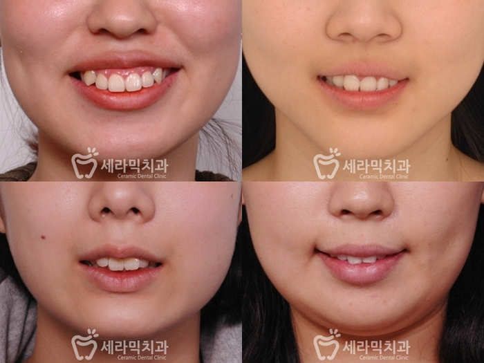 과개교합 치아교정 전후 올라간 입꼬리! 관련 이미지 2