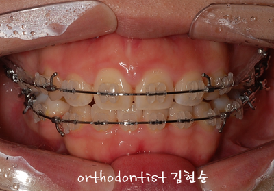 강남 돌출 관련 이미지 25