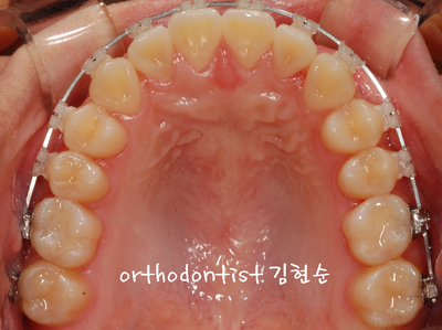 반대 교합 관련 이미지 23