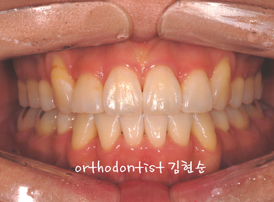 강남 덧니 관련 이미지 20