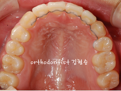 치열 교정(치열 불규칙) 관련 이미지 26