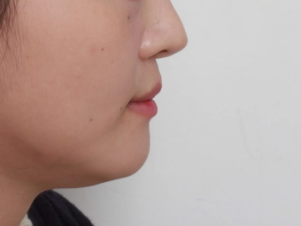 언주역 치과, 주걱턱 + 과개교합을 비수술로 치료한 사례 관련 이미지 10