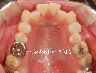 치열 교정(치열 불규칙) 관련 이미지 16