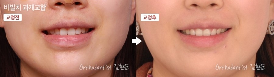 과개교합 무턱 개선 관련 이미지 14