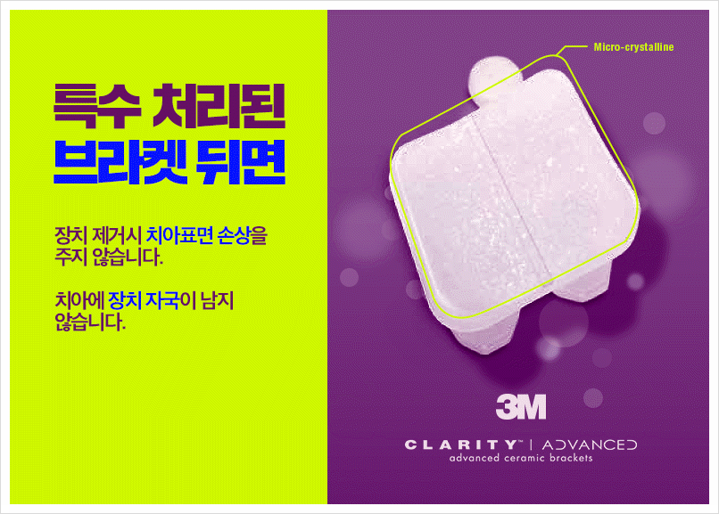 세라믹교정 단점을 보안한 클래러티 어드밴스 ~ 관련 이미지 9
