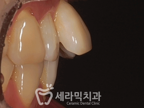 성인교정, 40대 50대 치아교정 잘하는 세라믹치과 치아교정전후 관련 이미지 8