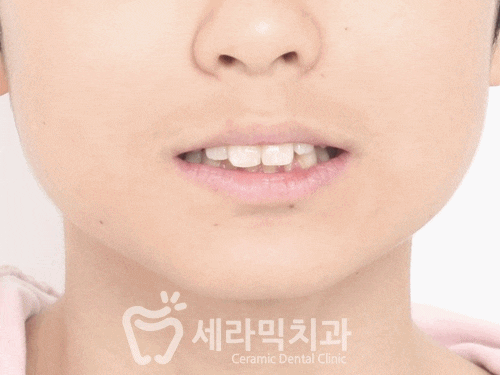 청소년교정 10대교정 딥바이트 과개교합 치아교정전후 관련 이미지 11
