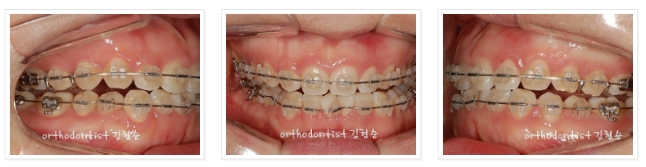 과개교합 ABP 교정 관련 이미지 11