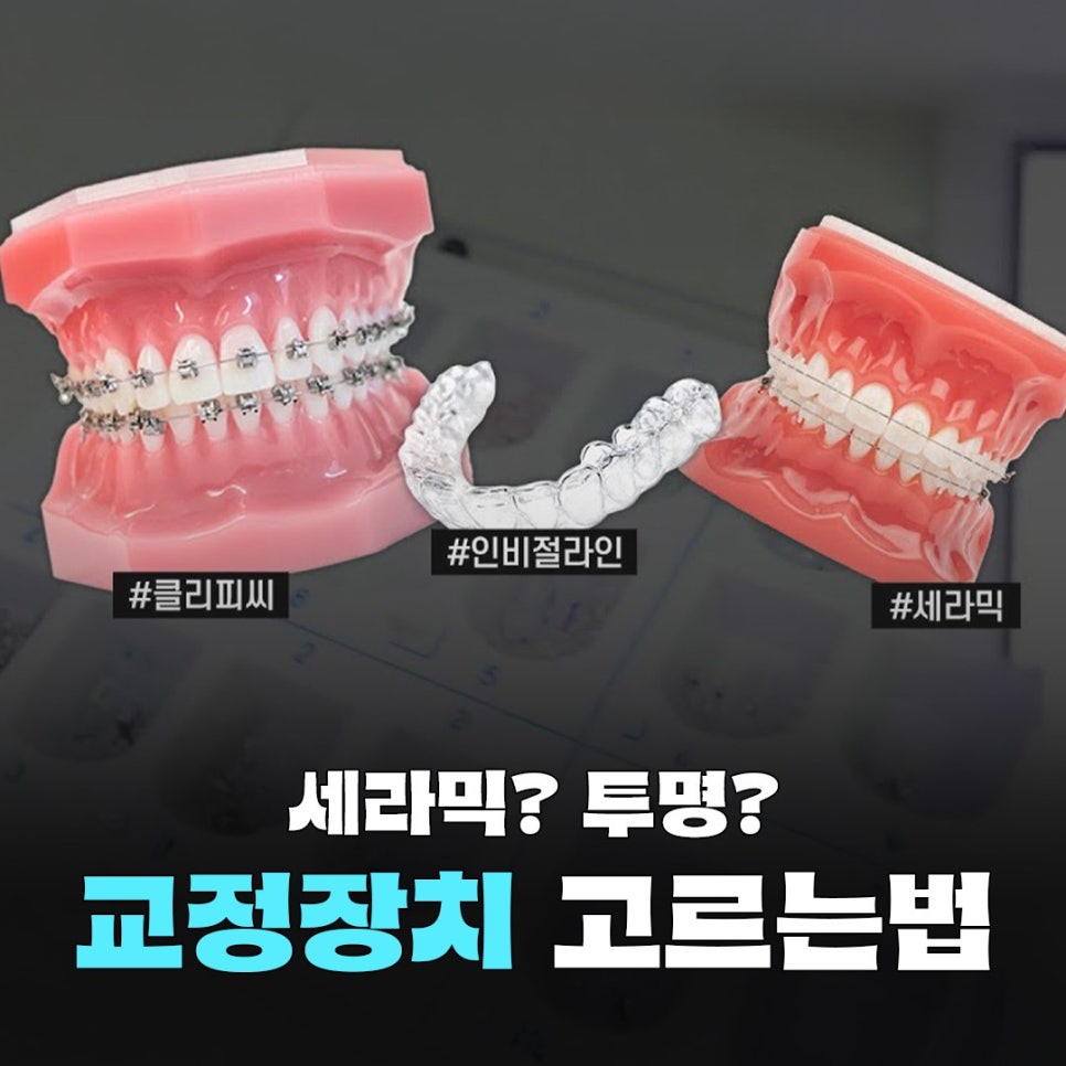 How to Choose an Orthodontic Appliance Without Regret image 1