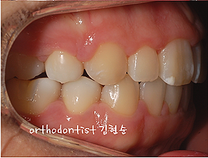 강남 돌출입 교정 관련 이미지 26