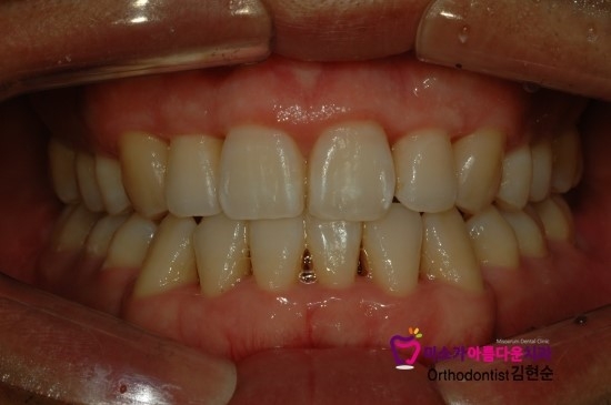 학동역치아교정잘하는치과 미소가아름다운치과 덧니교정 과정 관련 이미지 3