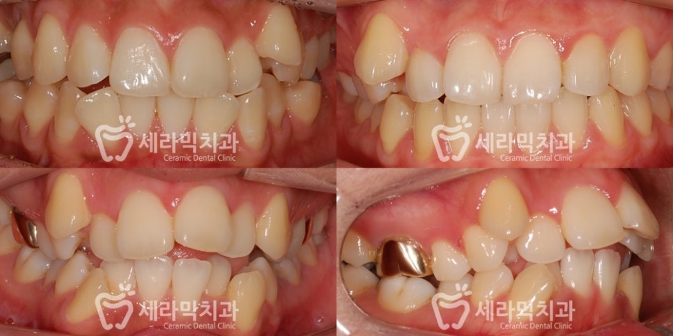 덧니 치아교정잘하는곳, 강남 세라믹치과 관련 이미지 2