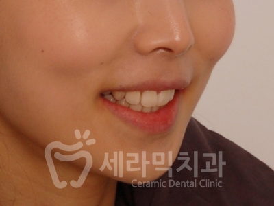 돌출입 덧니 비대칭 치아교정 전후 인상변화! 관련 이미지 17