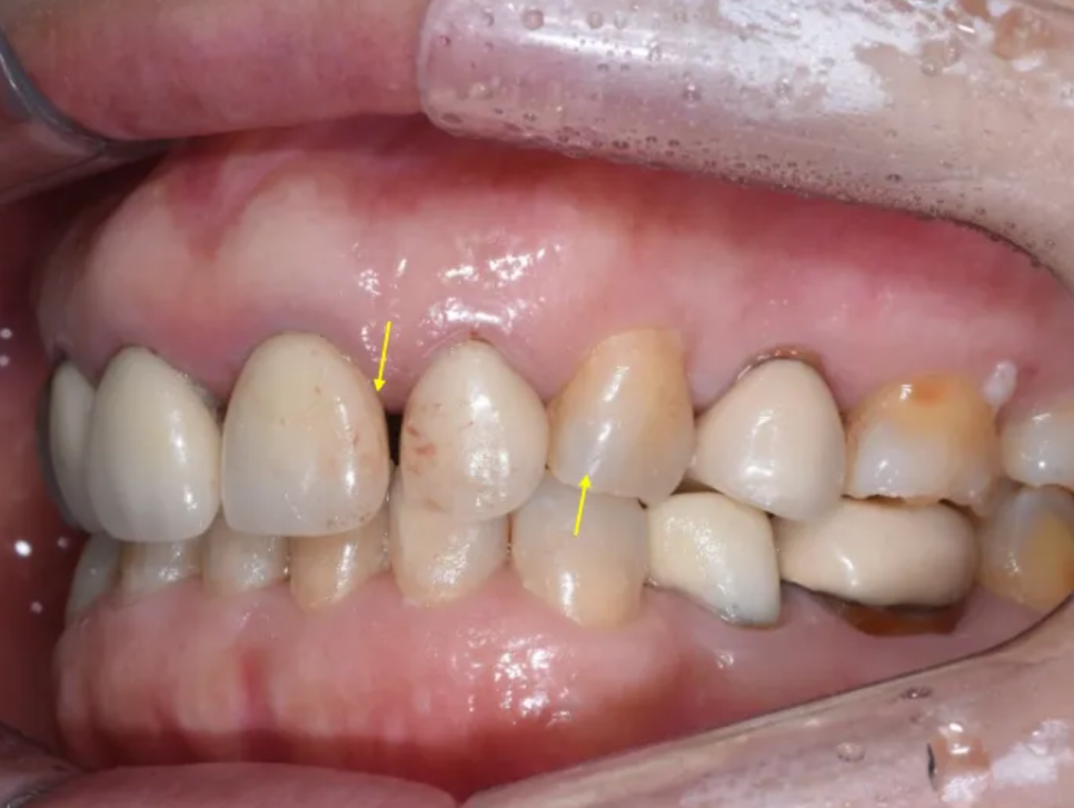 일본에서 거절당했던 앞니 심미보철 크라운 관련 이미지 7