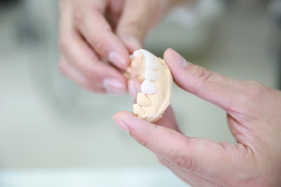 치아 라미네이트, 하기 전에 꼭 알아야 할 것들 정리 관련 이미지 7