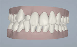 학동역치과 하면 세라믹교정 ~ 관련 이미지 24