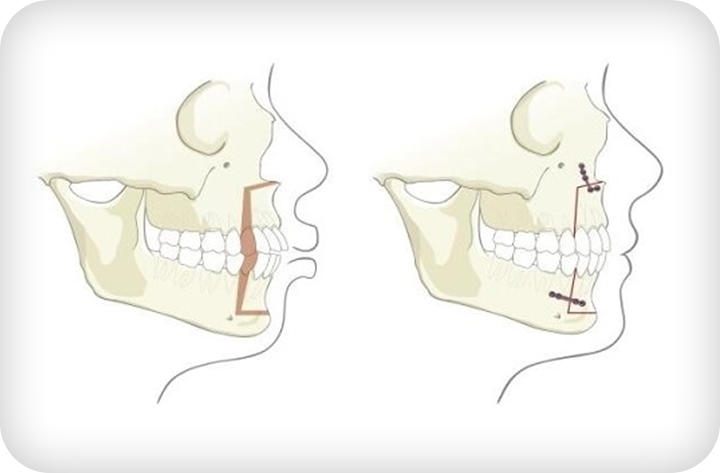 강남치아교정 브라켓비교분석 관련 이미지 12