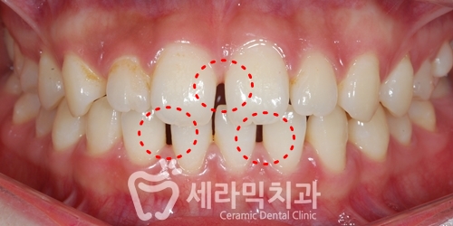 벌어진치아 세라믹교정 치아교정전후 세라믹치과 관련 이미지 1