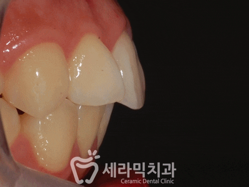 돌출입 치아교정전후. 갸름하고 세련된 입술을 되찾다! 관련 이미지 2