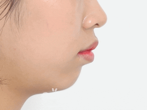 돌출입 치아교정전후 : 세련된 얼굴라인 찾기 성공! 관련 이미지 1