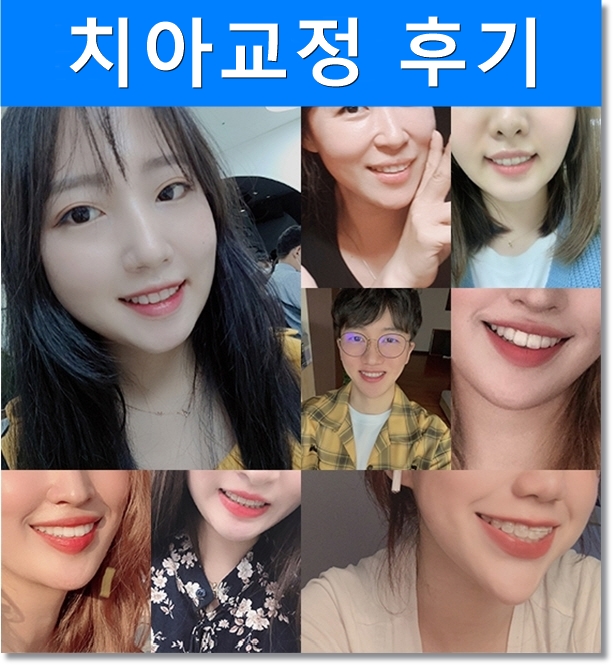 과개교합 치아교정 전후 올라간 입꼬리! 관련 이미지 5