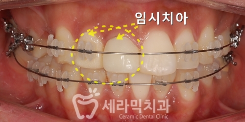 깨진 후에 후회하는 돌출입, 치아교정으로 건강하고 가지런한 치아만들기 관련 이미지 16