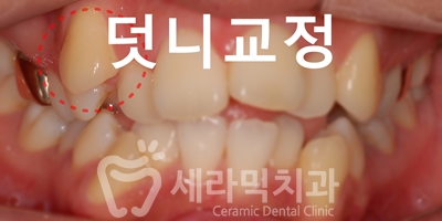 덧니와 돌출입을 한번에! 치아교정 전후사진 관련 이미지 2