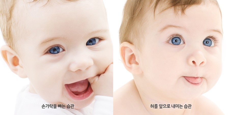 과개교합 무턱 개선 관련 이미지 2