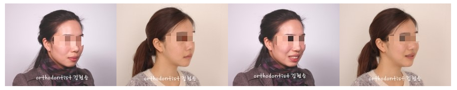 발치 돌출입교정으로 인상개선, 동안 만들기 관련 이미지 12