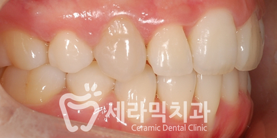 치아교정 전후 스마일라인 변화!(돌출입,토끼앞니, 중심선 비대칭 동시 교정) 관련 이미지 14