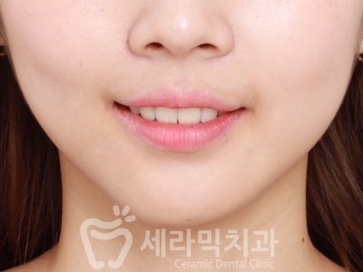 과개교합 치아교정잘하는곳, 세라믹치과 치아교정전후! 관련 이미지 21