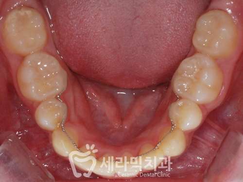 돌출입교정, 심미성과 치아 건강을 동시에 해결! 관련 이미지 29