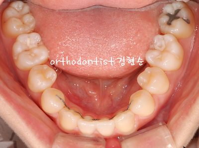 개방 교합 관련 이미지 28