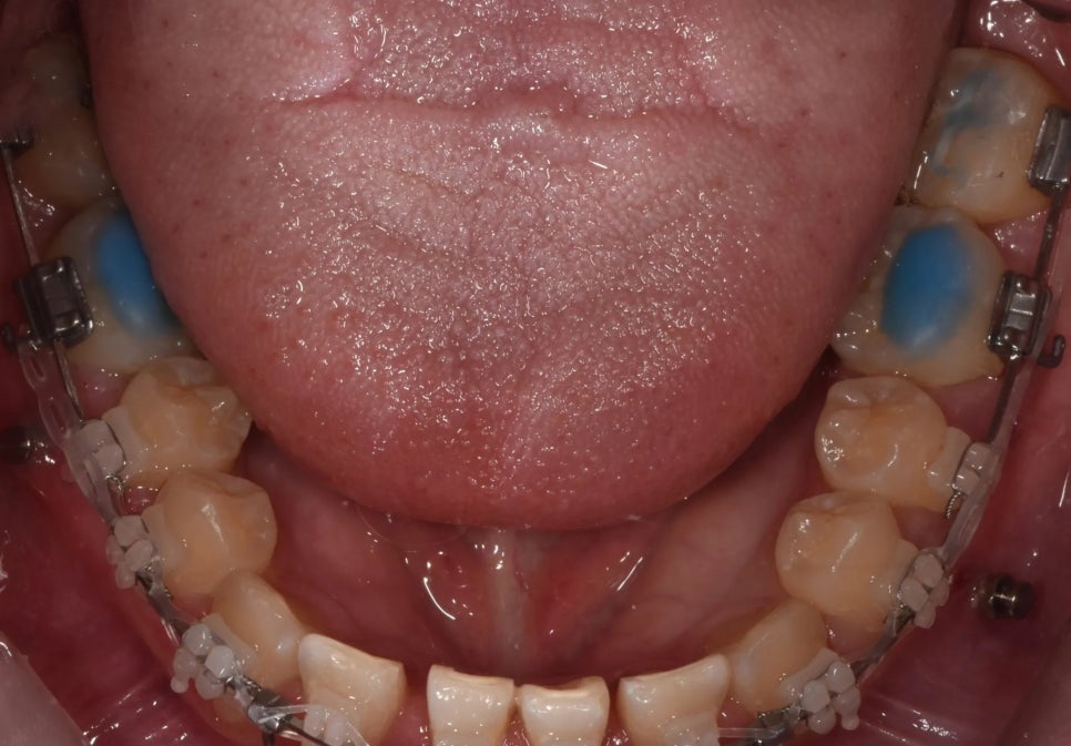 언주역 치과, 주걱턱 + 과개교합을 비수술로 치료한 사례 관련 이미지 7