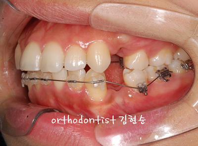 강남 돌출 관련 이미지 20