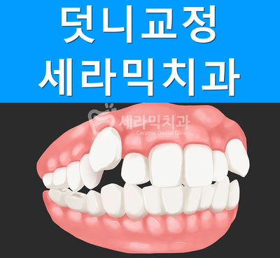 비발치 덧니교정으로 자신감 UP! 치아건강도 UP! 관련 이미지 1