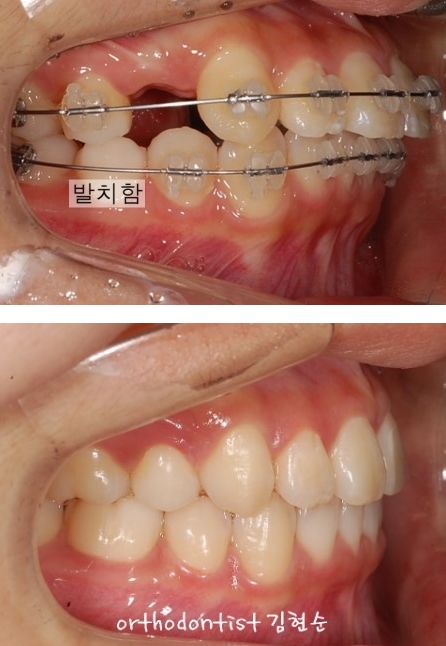 세라믹교정 은 세라믹치과 발치비발치 해결 관련 이미지 8