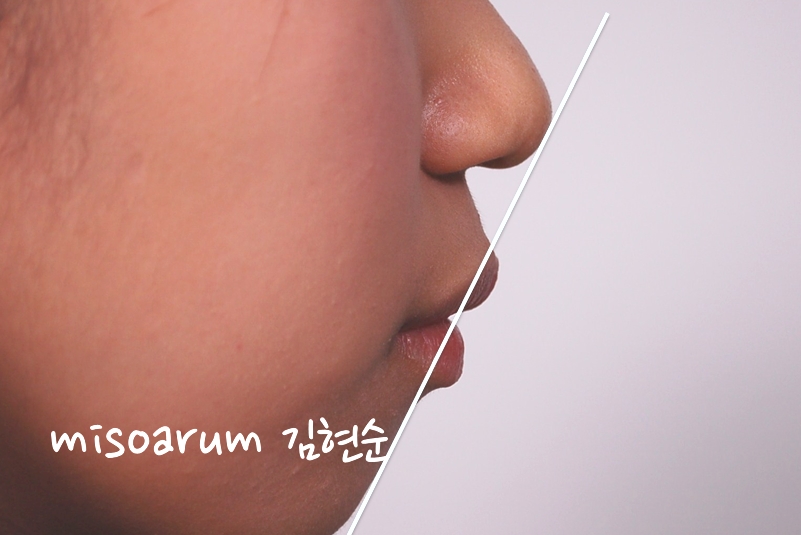 세라믹교정 은 세라믹치과 돌출입교정 관련 이미지 7