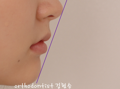 강남 돌출 (토끼 치아) 관련 이미지 34