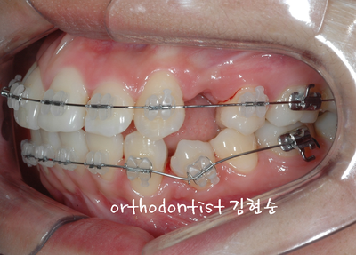 강남 돌출 관련 이미지 14