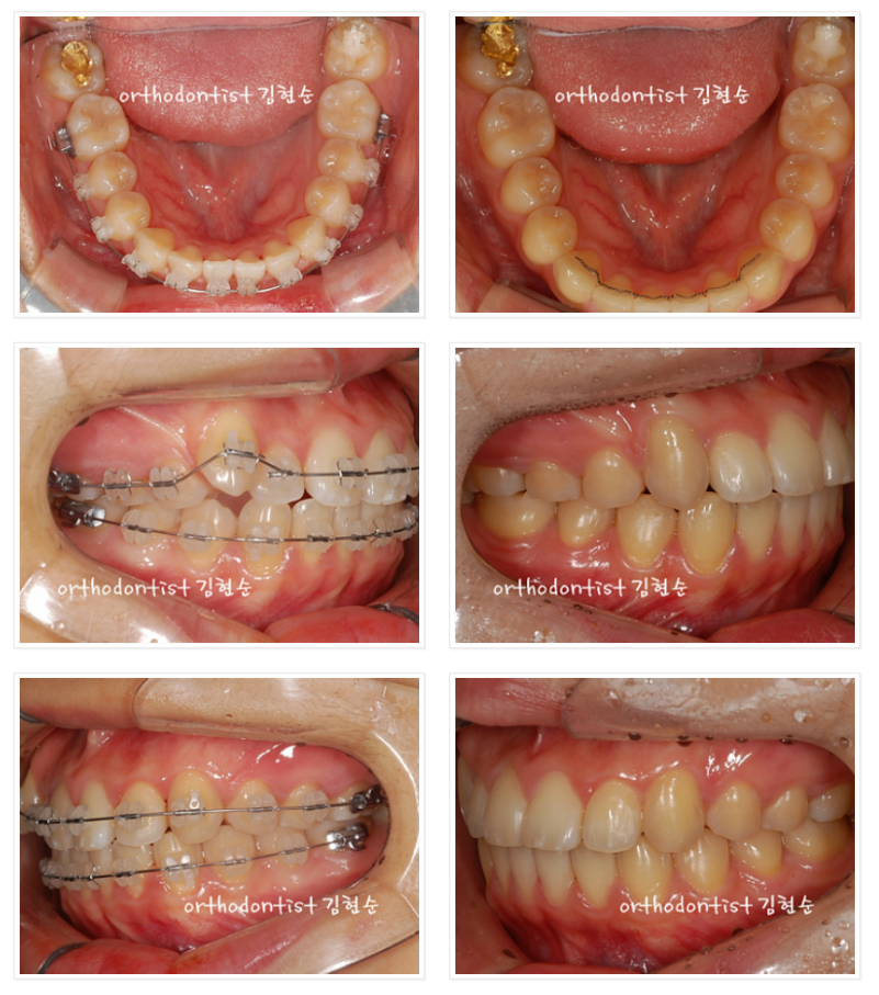 비발치로 덧니의 치열을 개선, 중심선을 맞추는 교정. 관련 이미지 4
